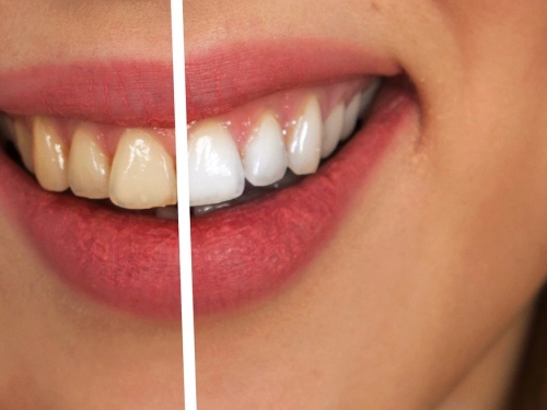 Jak uzyskać bielsze zęby? Moc węgla aktywnego